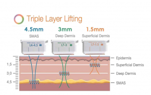 triple layer lifting 4.5mm 3.0mm 1.5mm
