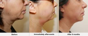 HIFU Facelift Before and After