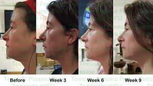 HIFU Facelift, before and after
