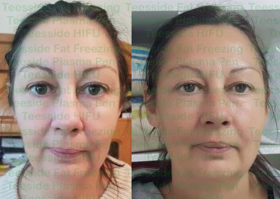HIFU Face lift, before and 3 months after