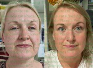 HIFU Face lift before and 6 weeks after